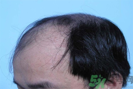 脫發(fā)的措施有什么？脫發(fā)的注意飲食有哪些？