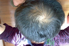脫發(fā)的高發(fā)人群有哪些？如何預(yù)防脫發(fā)？