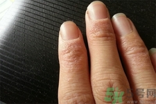 手足癬的治療方法？治療手足癬可以用什么藥？