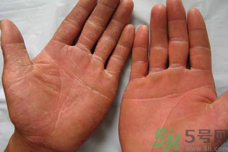 手足癬的治療方法？治療手足癬可以用什么藥？