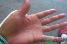 手足癬的易發(fā)人群有哪些？如何預(yù)防手足癬？