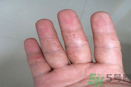 手足癬的易發(fā)人群有哪些？如何預(yù)防手足癬？