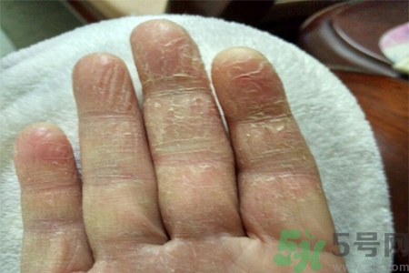 手足癬會傳染嗎？手足癬的傳播途徑有哪些？