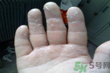 手足癬會傳染嗎？手足癬的傳播途徑有哪些？