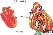 心臟病的癥狀是什么？心臟病的種類有哪些？