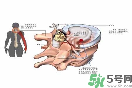 為什么年輕人容易得頸椎??？頸椎病嚴(yán)重的癥狀有哪些？