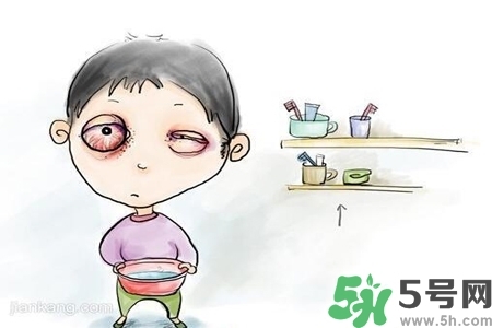 寶寶為什么會感染紅眼??？寶寶患紅眼病如何治療？