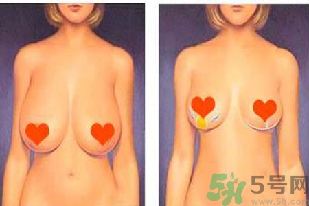 ?女性乳房下垂的原因是什么？女性乳房下垂的分類有哪些？