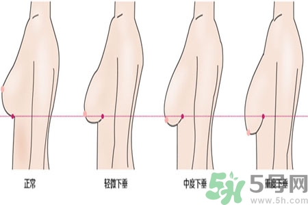 ?女性乳房下垂的原因是什么？女性乳房下垂的分類有哪些？