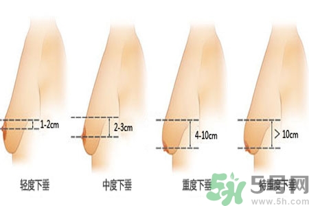 ?女性乳房下垂的原因是什么？女性乳房下垂的分類有哪些？
