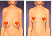 ?女性乳房下垂的原因是什么？女性乳房下垂的分類有哪些？