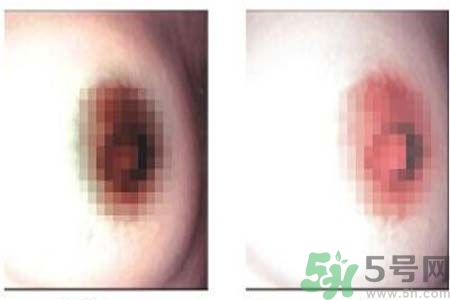 乳頭發(fā)黑是怎么回事？乳頭發(fā)黑是什么原因？
