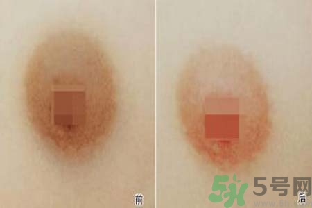 乳頭發(fā)黑是怎么回事？乳頭發(fā)黑是什么原因？