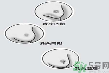 乳頭內(nèi)陷怎么回事？乳頭內(nèi)陷的原因是什么？