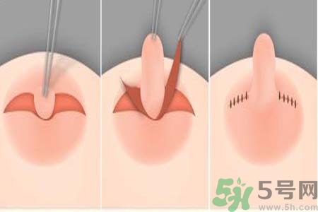 乳頭內(nèi)陷怎么回事？乳頭內(nèi)陷的原因是什么？