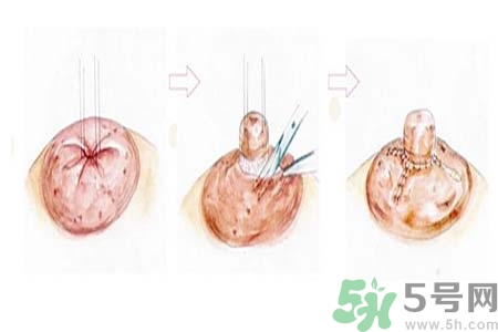 乳頭內(nèi)陷怎么回事？乳頭內(nèi)陷的原因是什么？