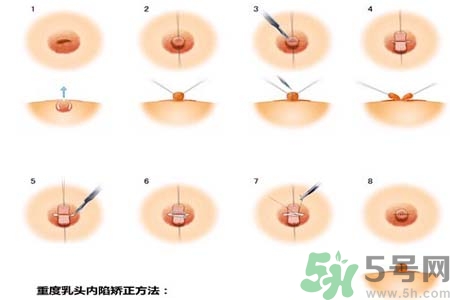 乳頭內(nèi)陷怎么回事？乳頭內(nèi)陷的原因是什么？