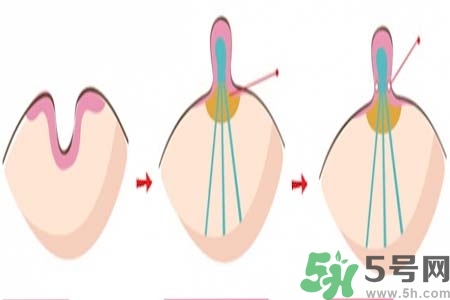 乳頭內(nèi)陷怎么辦？乳頭內(nèi)陷的癥狀有哪些？