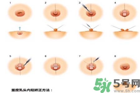 乳頭內(nèi)陷怎么辦？乳頭內(nèi)陷的癥狀有哪些？