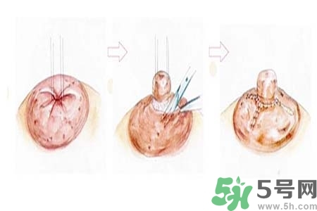 乳頭內(nèi)陷怎么辦？乳頭內(nèi)陷的癥狀有哪些？