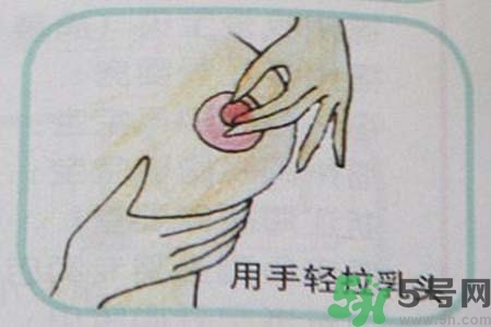 乳頭內(nèi)陷怎么辦？乳頭內(nèi)陷的癥狀有哪些？