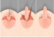 乳頭內(nèi)陷怎么辦？乳頭內(nèi)陷的癥狀有哪些？
