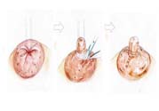 乳頭內(nèi)陷矯正需注意什么？乳頭內(nèi)陷如何預(yù)防？