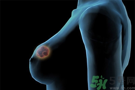 乳房屋硬塊有疼痛感怎么回事？乳房屋硬塊有疼痛感怎么辦？