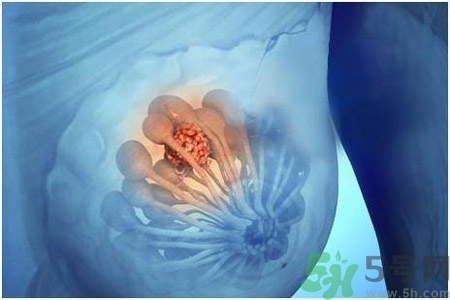 乳房屋硬塊有疼痛感怎么回事？乳房屋硬塊有疼痛感怎么辦？