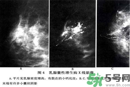 產(chǎn)生乳腺增生鈣化的病因是什么？乳腺增生怎樣治療？