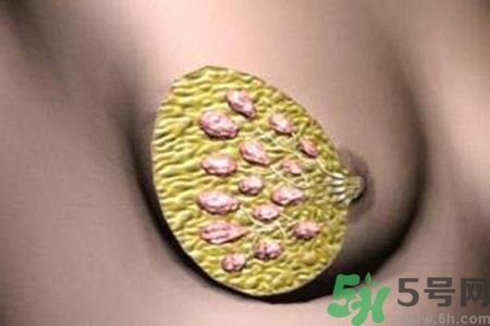 乳腺增生鈣化是什么？乳腺鈣化的癥狀有哪些？