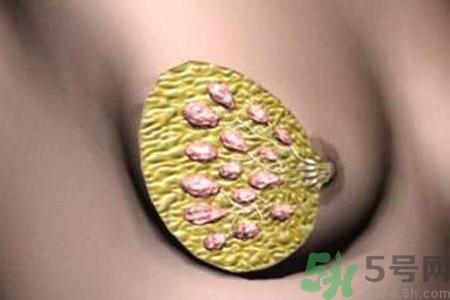 產(chǎn)生乳腺增生鈣化的病因是什么？乳腺增生怎樣治療？