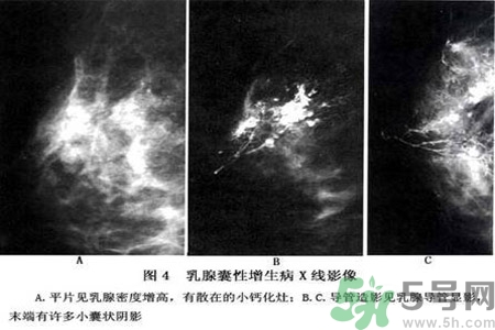 乳腺增生鈣化是什么？乳腺鈣化的癥狀有哪些？