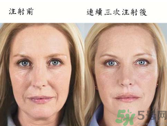 3D液態(tài)拉皮多少錢？3D液態(tài)拉皮后多久見(jiàn)效？