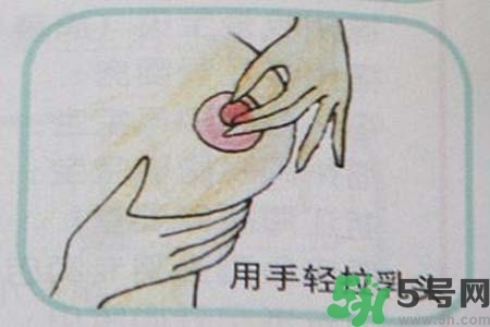 乳頭內(nèi)陷怎么矯正？乳頭內(nèi)陷矯正方法是什么？