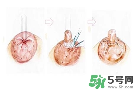 乳頭內(nèi)陷怎么矯正？乳頭內(nèi)陷矯正方法是什么？