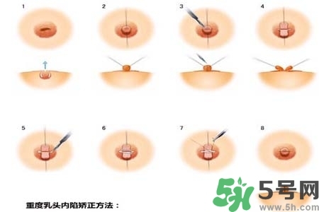 乳頭內(nèi)陷怎么矯正？乳頭內(nèi)陷矯正方法是什么？
