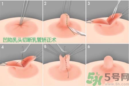 乳頭內(nèi)陷怎么矯正？乳頭內(nèi)陷矯正方法是什么？