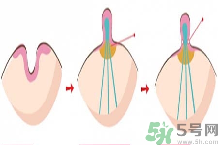 乳頭內(nèi)陷矯正需注意什么？乳頭內(nèi)陷如何預防？