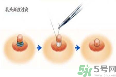 乳頭內(nèi)陷能不能喂奶？乳頭凹陷怎樣哺乳？