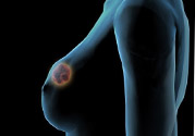 哺乳期乳房有硬塊疼痛怎么辦？如何預防哺乳期乳房有硬塊？