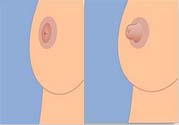 乳頭內(nèi)陷可以用吸奶器嗎？乳頭內(nèi)陷能不能用吸奶器？