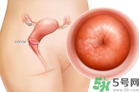 陰道出血癥狀有哪些？陰道出血需注意什么問(wèn)題？