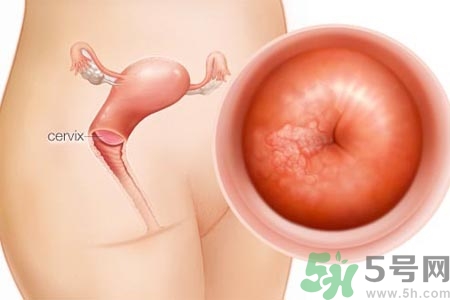 陰道松弛是什么？陰道松弛的癥狀有哪些？