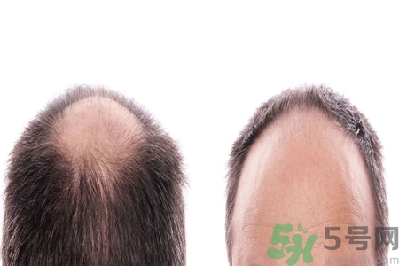 頭發(fā)稀少的原因是什么？如何預(yù)防禿頂?shù)陌l(fā)生？