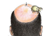 禿頂會遺傳嗎？治療禿頂?shù)姆椒ㄊ鞘裁矗?><p><strong>禿頂會遺傳嗎？治療禿頂?shù)姆椒ㄊ鞘裁矗?/strong></p></a></li> </ul>
</div>
<div   id=