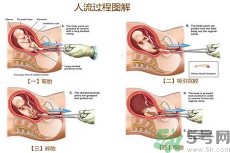 人工流產(chǎn)后多久可以再次懷孕？流產(chǎn)后需要注意什么？