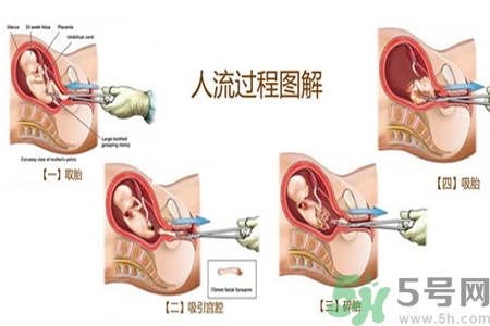 人工流產(chǎn)后多久可以再次懷孕？流產(chǎn)后需要注意什么？