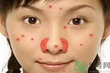 鼻翼長痘痘怎么回事？鼻翼長痘痘的原因是什么？