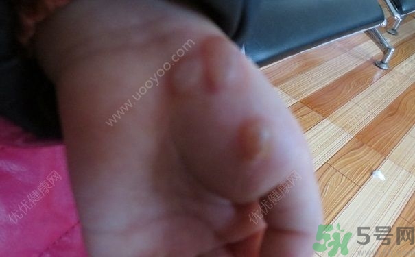 15歲還會(huì)得手足口病嗎？手足口病的癥狀有哪些？